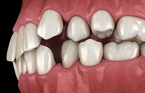 Illustration of gapped teeth