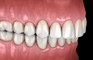 Illustration of an overbite