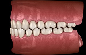 Illustration of an underbite