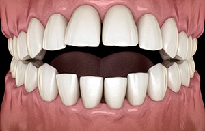 Illustration of an open bite