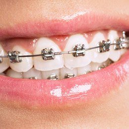 How to Care for Ceramic Braces - Tennison Orthodontics Cleburne, TX